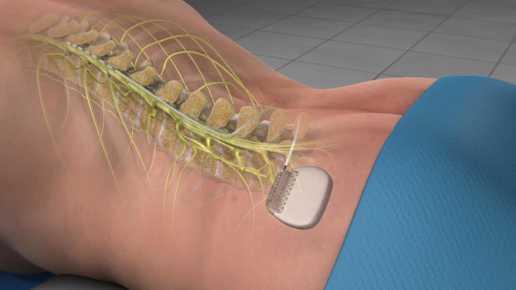 Spinal Cord Stimulation