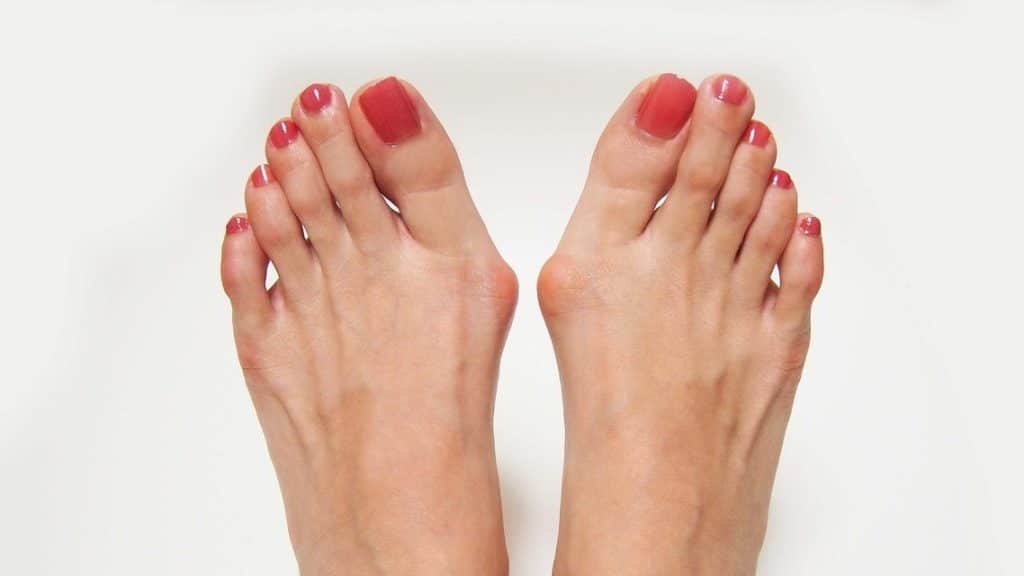 Causes and Symptoms of Bunions