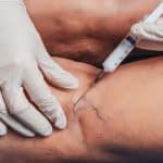 Cosmetic Vein Treatment