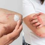 Fungal Skin Infections
