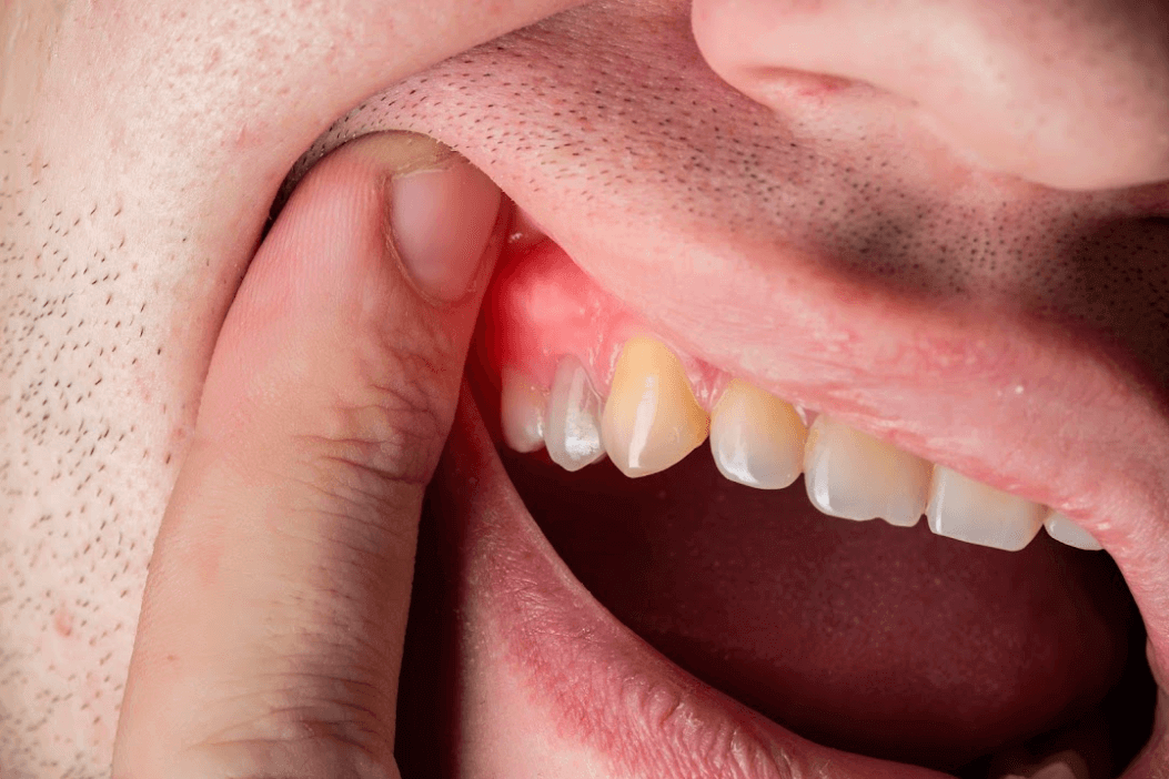 Gum Disease