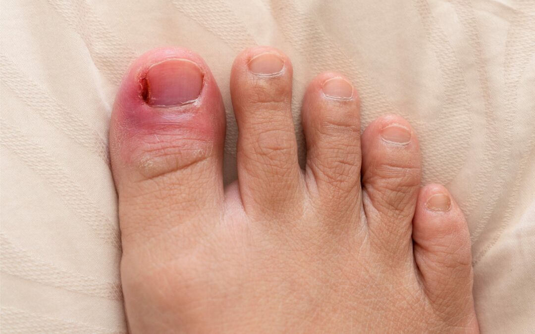 Ingrown Toenails