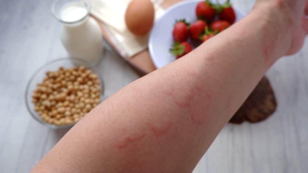 Food Allergy